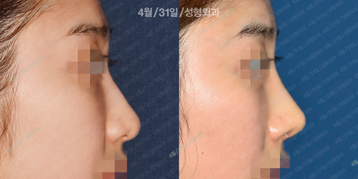 측면