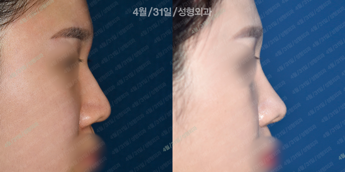 측면