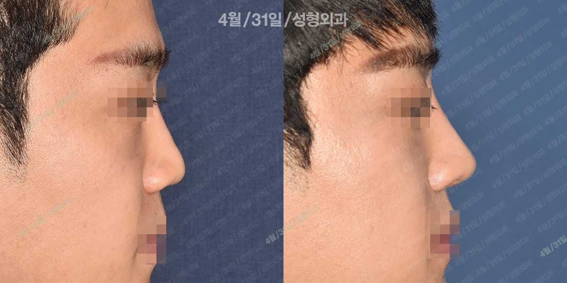 측면