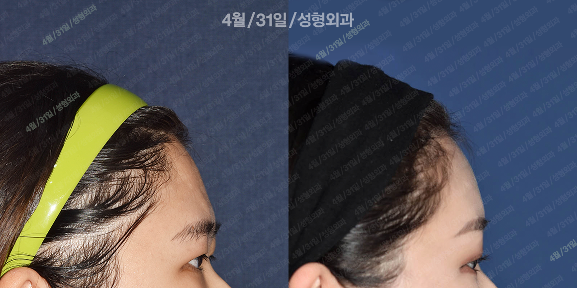측면