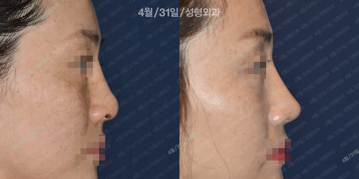 측면